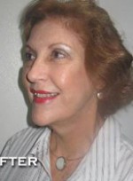 Face Lift