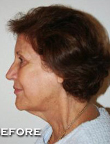 Face Lift