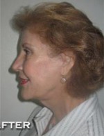Face Lift