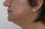 Face Lift