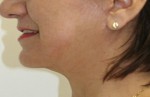 Face Lift