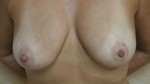Breast Reconstruction after Mastectomy