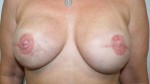 Breast Reconstruction after Mastectomy