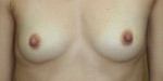 Breast Reconstruction after Mastectomy