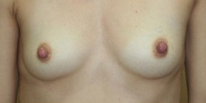 Breast Reconstruction after Mastectomy