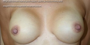 Breast Reconstruction after Mastectomy