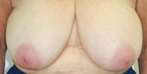 Breast Reconstruction after Mastectomy