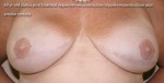 Breast Reconstruction after Mastectomy