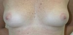 Breast Reconstruction after Mastectomy