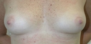 Breast Reconstruction after Mastectomy