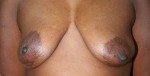 Breast Reconstruction after Mastectomy
