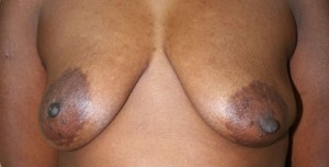 Breast Reconstruction after Mastectomy