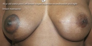 Breast Reconstruction after Mastectomy