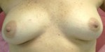 Breast Reconstruction after Mastectomy