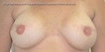 Breast Reconstruction after Mastectomy
