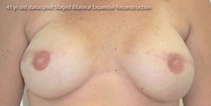 Breast Reconstruction after Mastectomy