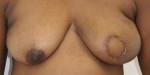 Breast Reconstruction after Mastectomy