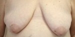 Breast Reconstruction after Mastectomy