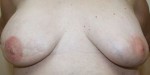 Breast Reconstruction after Mastectomy