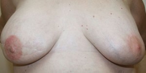 Breast Reconstruction after Mastectomy