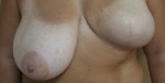 Breast Reconstruction after Mastectomy