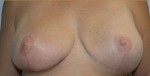 Breast Reconstruction after Mastectomy