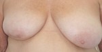 Breast Reconstruction after Mastectomy