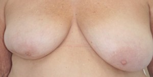 Breast Reconstruction after Mastectomy
