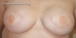 Breast Reconstruction after Mastectomy