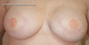 Breast Reconstruction after Mastectomy