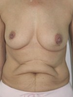 Breast Reconstruction after Mastectomy