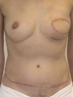 Breast Reconstruction after Mastectomy