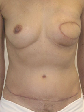 Breast Reconstruction after Mastectomy