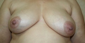 Breast Reconstruction after Mastectomy
