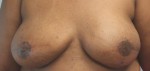 Breast Reconstruction after Mastectomy