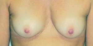 Breast Reconstruction after Mastectomy