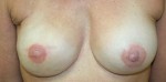 Breast Reconstruction after Mastectomy