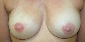 Breast Reconstruction after Mastectomy