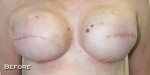 Breast Reconstruction after Mastectomy