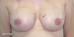 Breast Reconstruction after Mastectomy