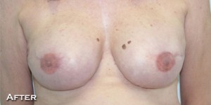Breast Reconstruction after Mastectomy