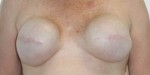 Breast Reconstruction after Mastectomy