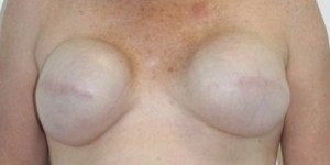 Breast Reconstruction after Mastectomy