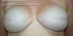 Breast Reconstruction after Mastectomy