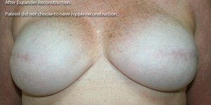 Breast Reconstruction after Mastectomy