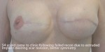 Breast Reconstruction after Mastectomy