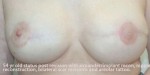 Breast Reconstruction after Mastectomy