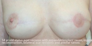 Breast Reconstruction after Mastectomy