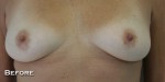 Breast Reconstruction after Mastectomy
