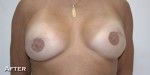 Breast Reconstruction after Mastectomy